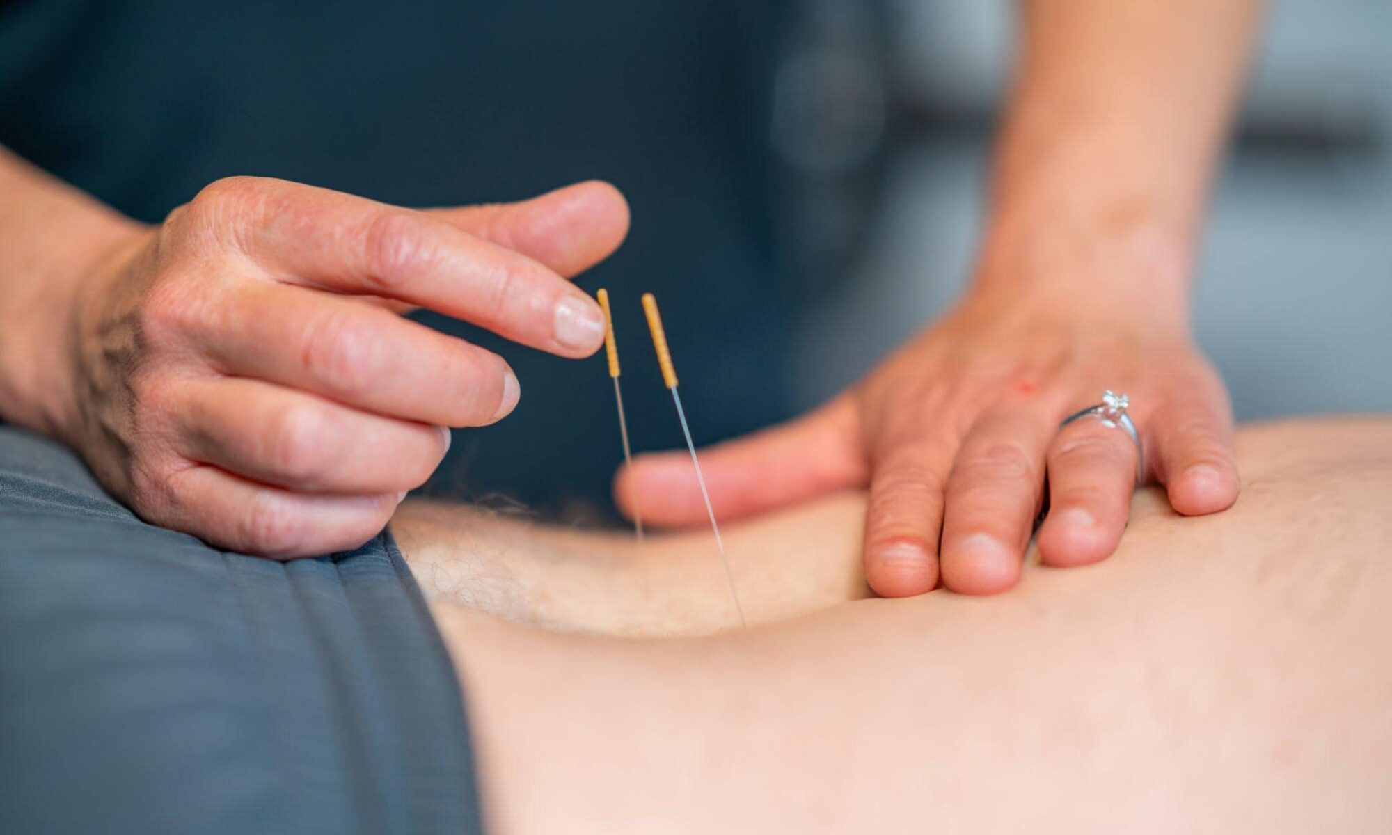 Dry needling to treat muscle pain