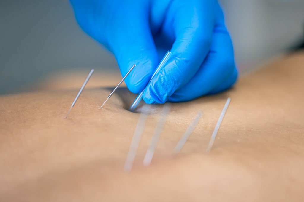 Benefits Of Dry Needling Therapy